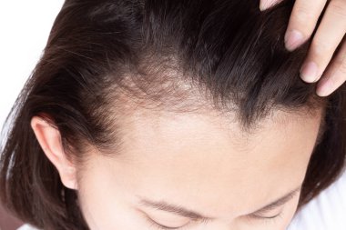 Unlocking The Secrets: What Causes Hair Breakage In The Front And How To Fix It