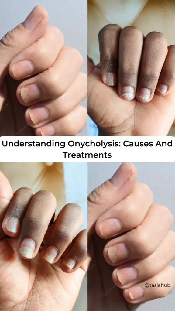 onycholysis of the nail pinterest image