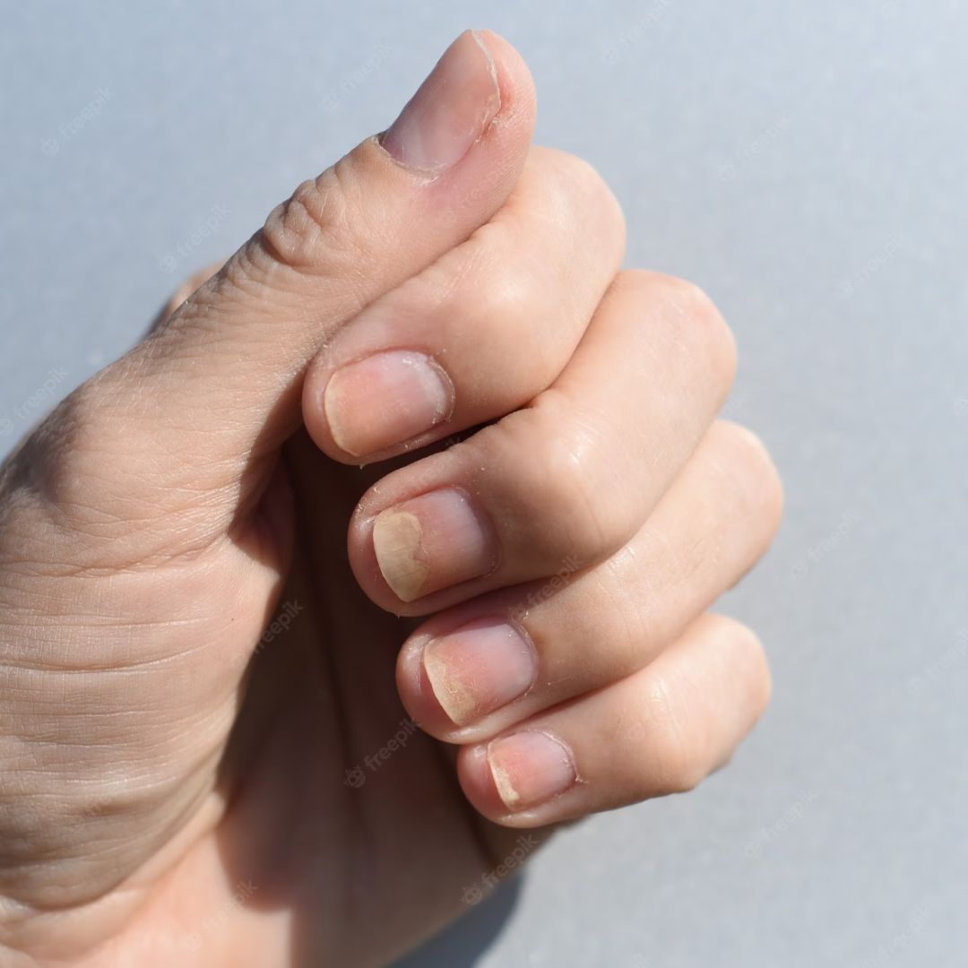 Understanding Onycholysis Of The Nail: Causes, Symptoms And Treatment