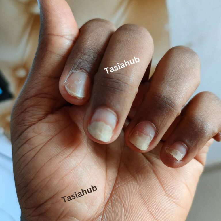 Understanding Onycholysis Of The Nail Causes, Symptoms And Treatment